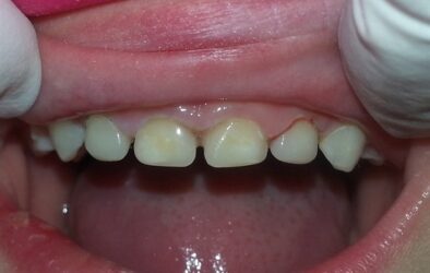 Odontología heroica: Coronas de tira para Leigh