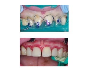 Leer más sobre el artículo Odontología heroica: Autismo grave, caries galopantes y coronas de tira