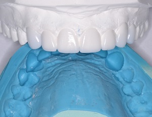 Leer más sobre el artículo Odontología Heroica: Rescate compasivo de sonrisas con ACTIVA BioACTIVE-RESTORATIVE