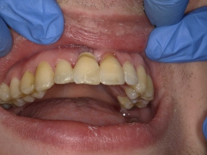 Leer más sobre el artículo Odontología Heroica: Traumatismo, reabsorción externa, extracción y ferulización de la corona natural con ACTIVA
