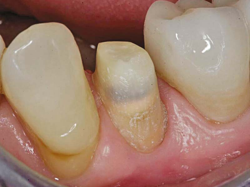 clinical-procedure-activa-cement-1