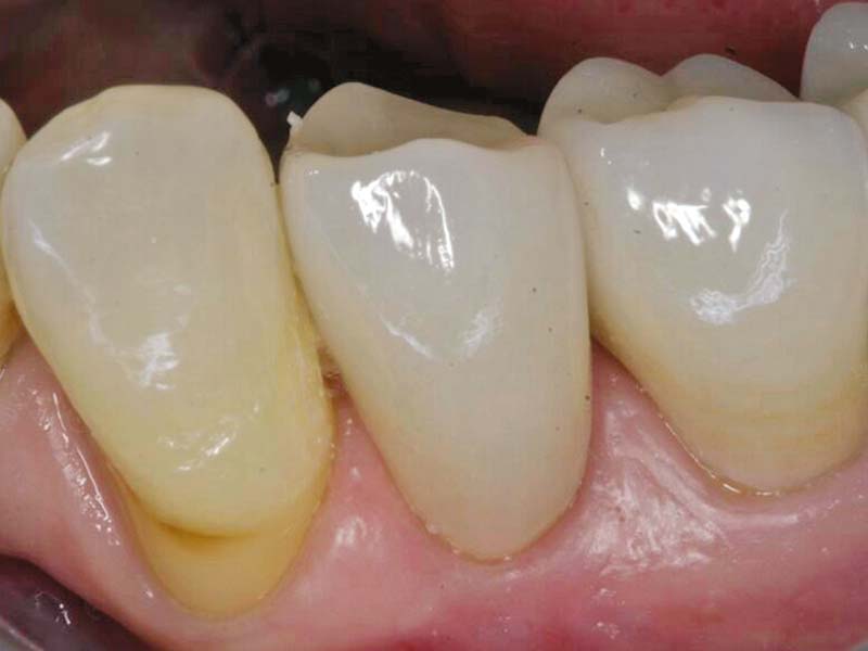 clinical-procedure-activa-cement-4