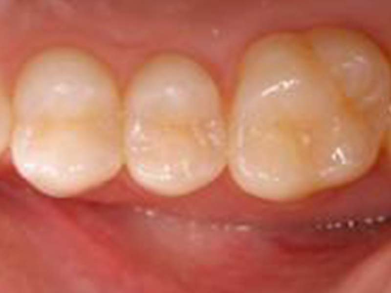 clinical-procedure-embrace-sealant-1