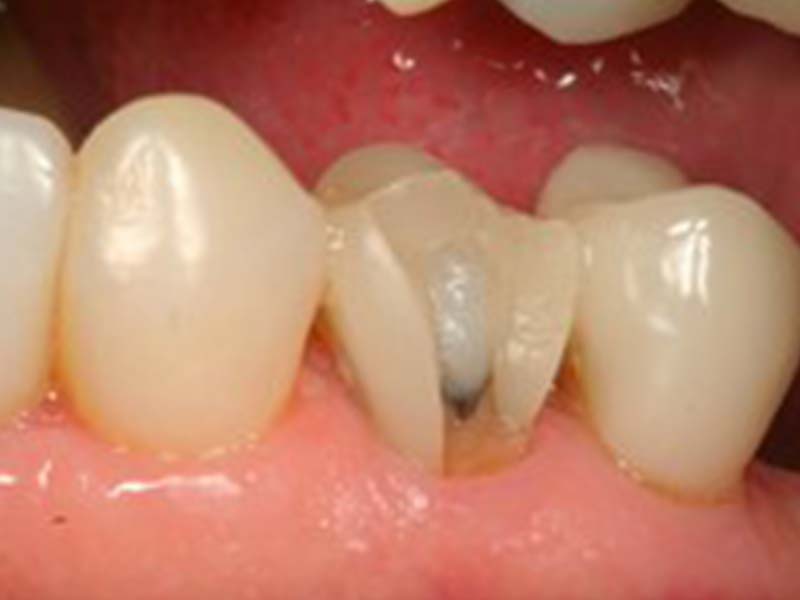 clinical-procedure-pfm-repair-kit-1