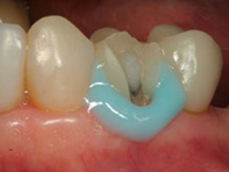 clinical-procedure-pfm-repair-kit-2