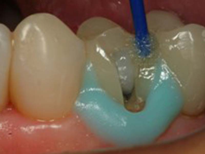 clinical-procedure-pfm-repair-kit-4