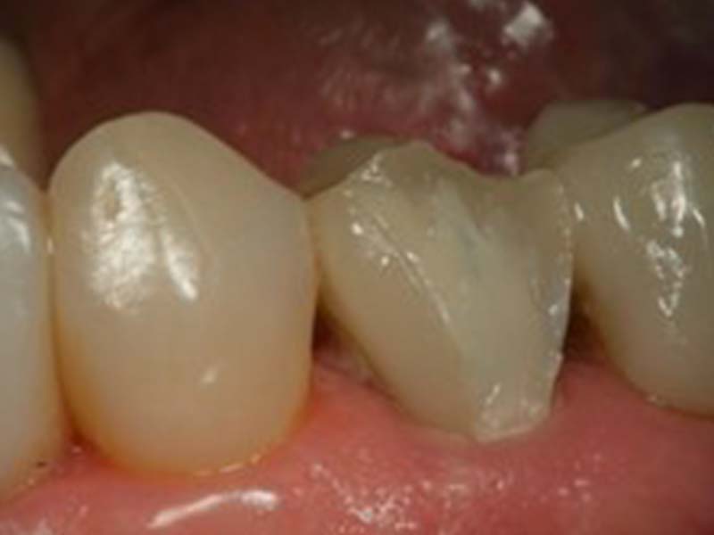 clinical-procedure-pfm-repair-kit-7