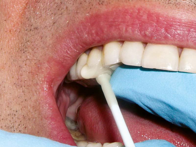clinical-procedure-pic-n-stic-2