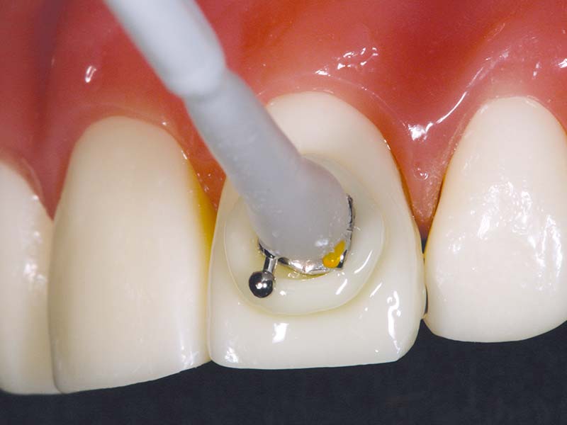 clinical-procedure-pic-n-stic-4