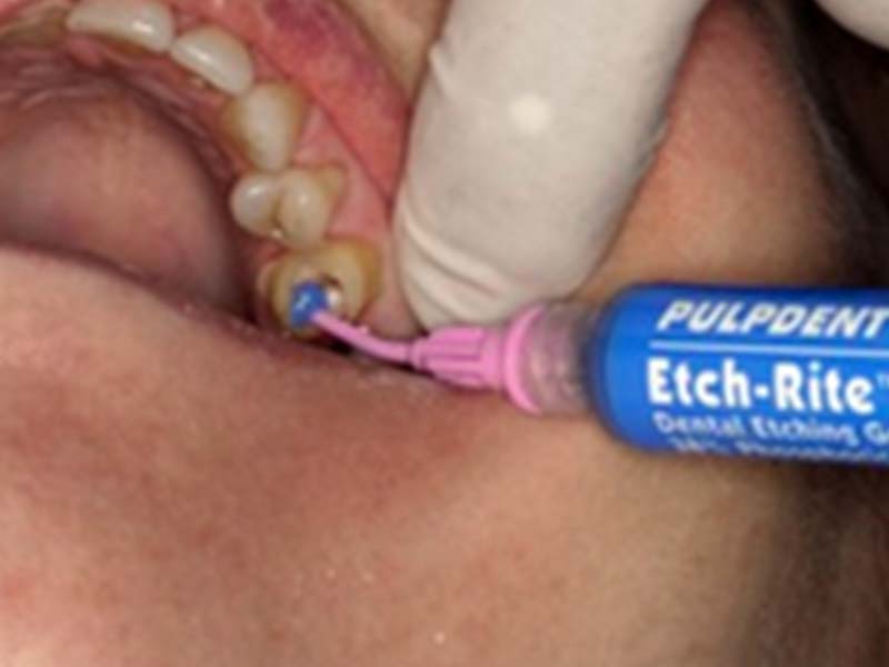 clinical-procedure1-embrace-ciment-2