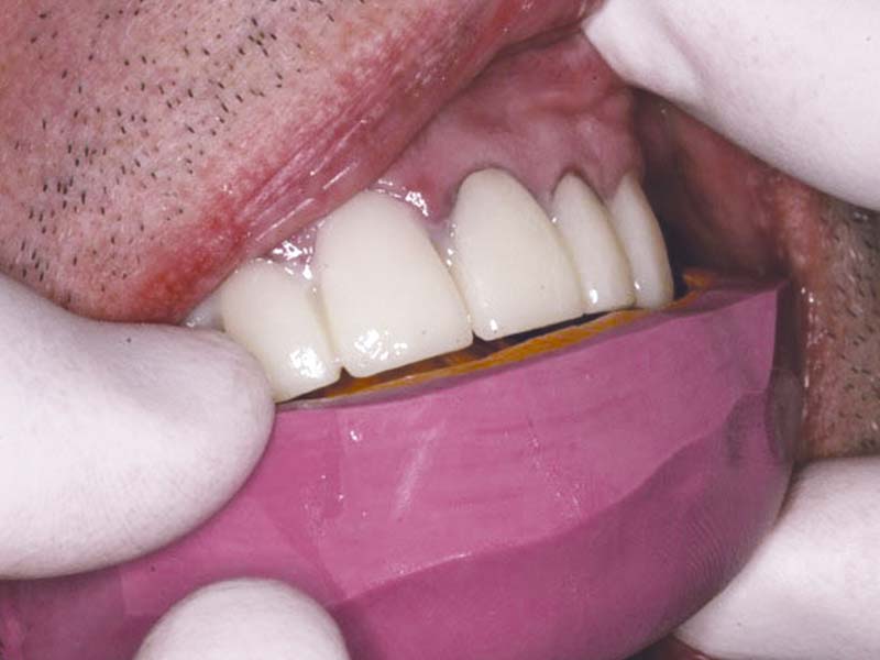 clinical-procedure1-tuff-temp-plus-2