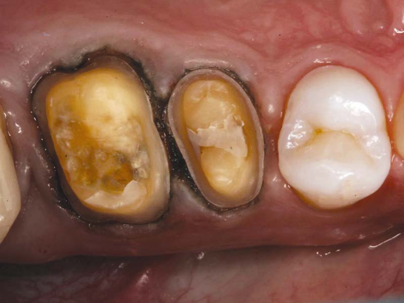 clinical-procedure2-tuff-temp-plus-1
