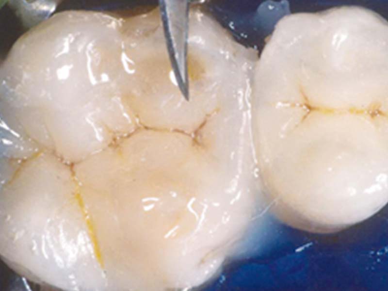 clinical-procedure3-flows-rite-3