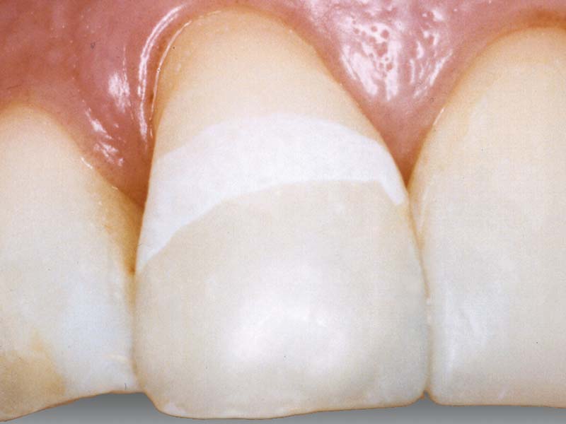 clinical-procedure3-seal-n-shine-1