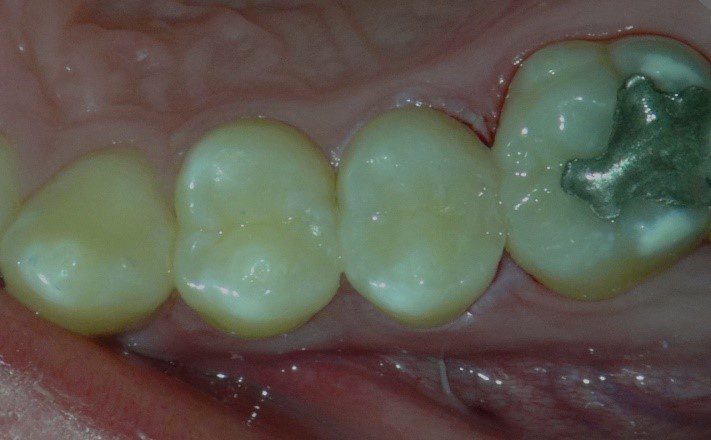 Leer más sobre el artículo Directo desde el quirófano: Restauraciones bioactivas mínimamente invasivas