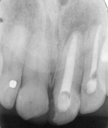 Tratamiento satisfactorio de una lesión periapical de larga duración
