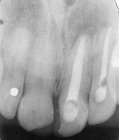 Leer más sobre el artículo Tratamiento satisfactorio de una lesión periapical de larga duración