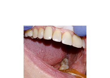 Leer más sobre el artículo Odontología heroica: Reutilizar una corona rota