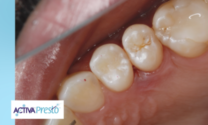 ¡NUEVO VIDEO! El Dr. Joshua Austin x Dental Economics presentan ACTIVA Presto