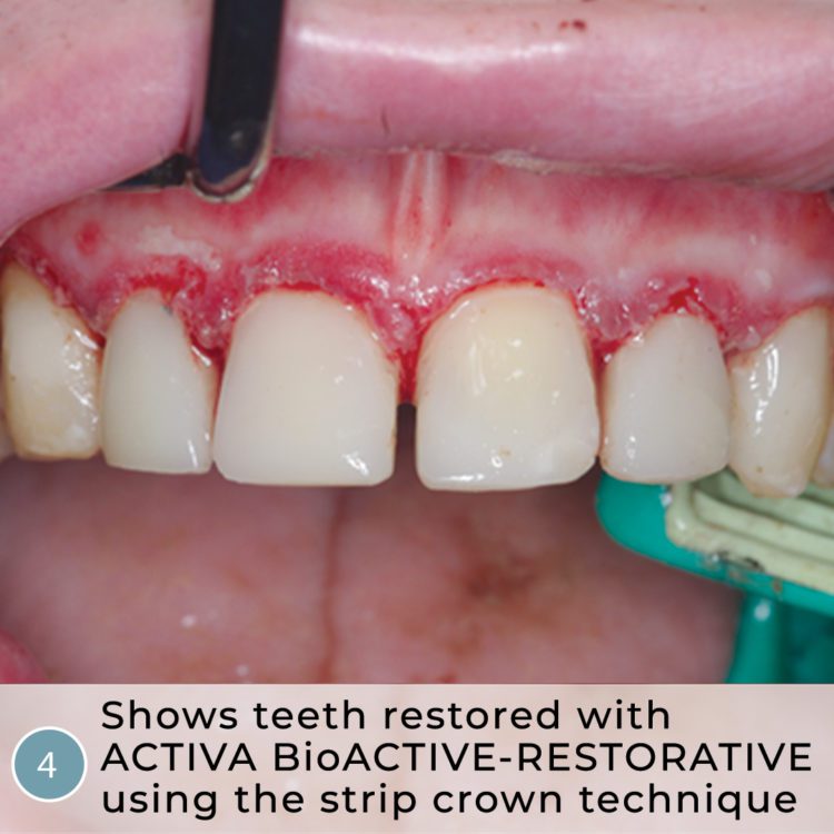 Leer más sobre el artículo Odontología heroica: Autismo grave, caries galopantes, coronas de tira y ACTIVA BioACTIVO-RESTAURABLE
