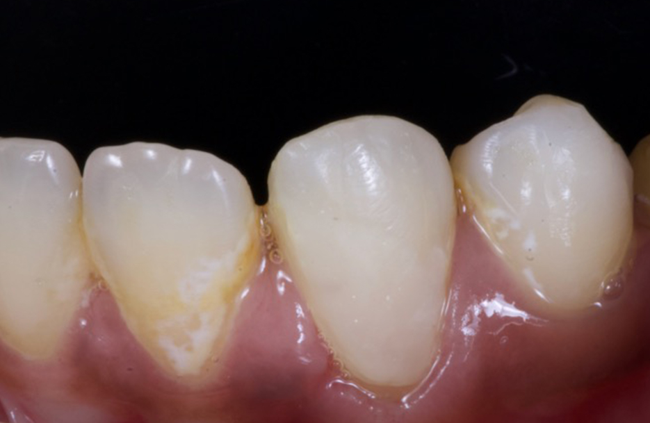 AFTER - Activa Presto Restoration using Crysta