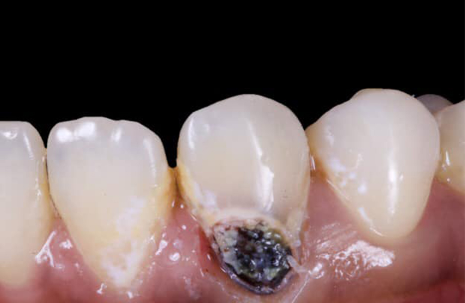 BEFORE - Activa Presto Restoration using Crysta