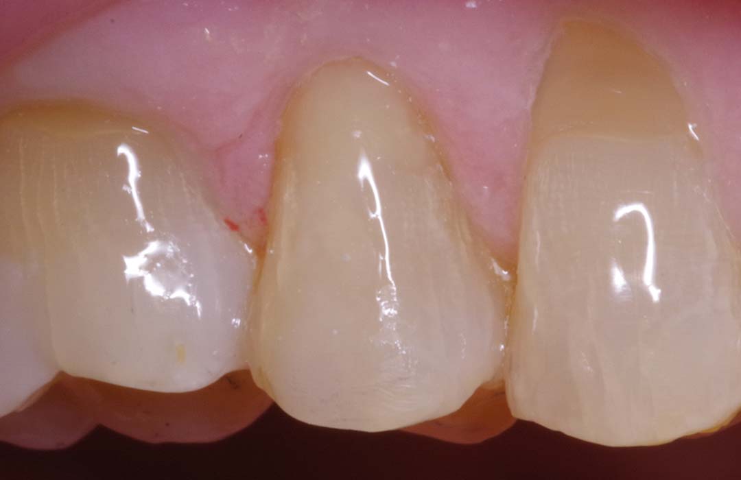 smile-zone-presto-after