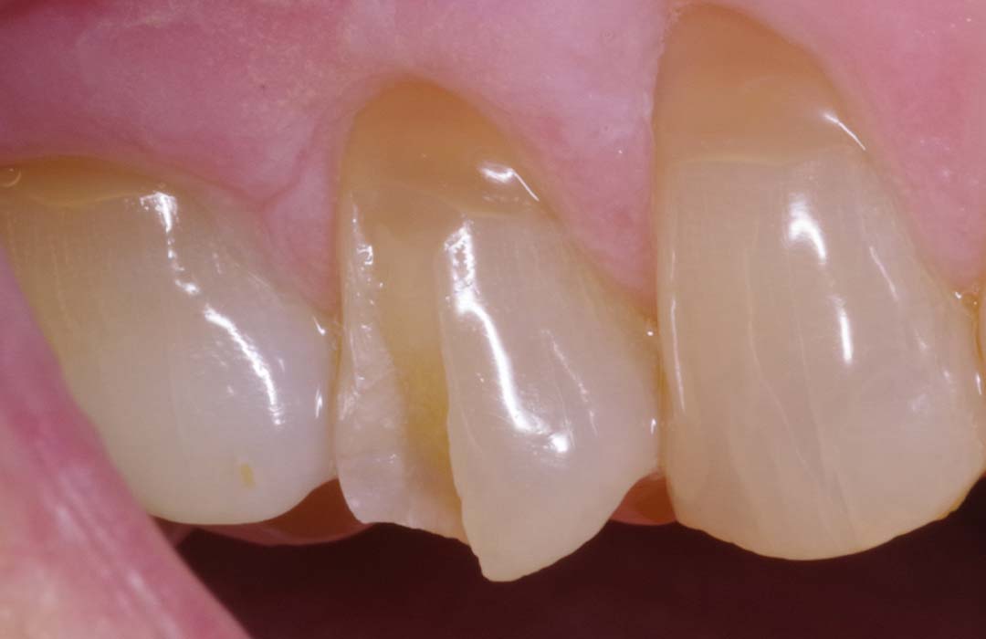 smile-zone-presto-before