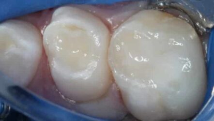 Restauraciones bioactivas en odontopediatría