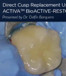 Sustitución directa de la cúspide mediante un material de restauración bioactivo