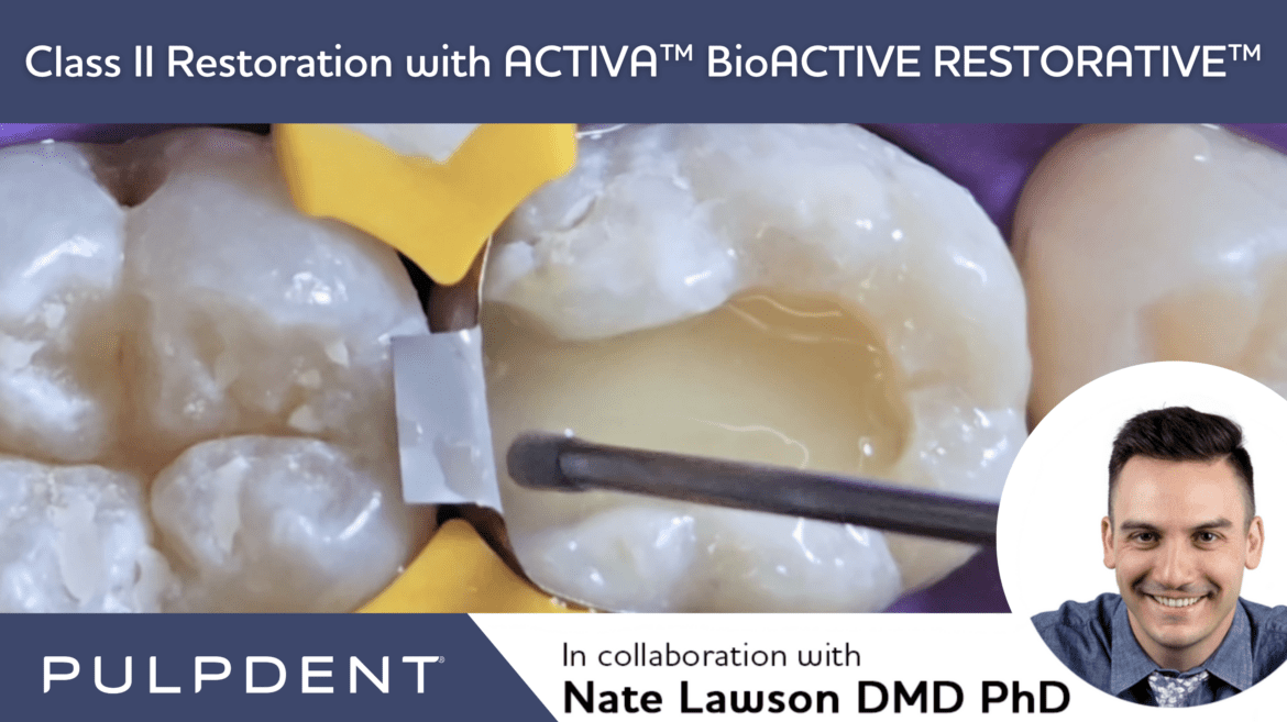 Restauración de clase II con ACTIVA™ BioACTIVE-RESTORATIVE™. - PULPDENT